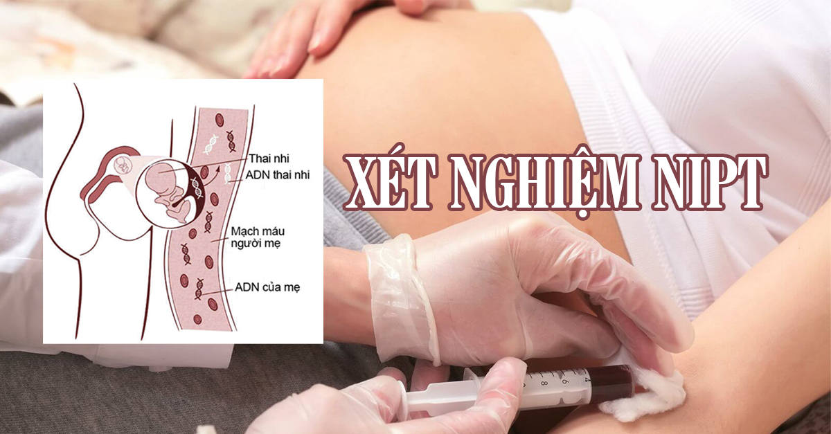 Thông tin mới cập nhật xét nghiệm NIPT 2024